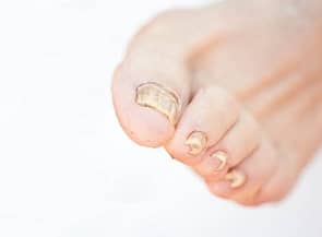 Sintomi unghie dei piedi cattive