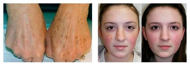 prima e dopo pelle del viso