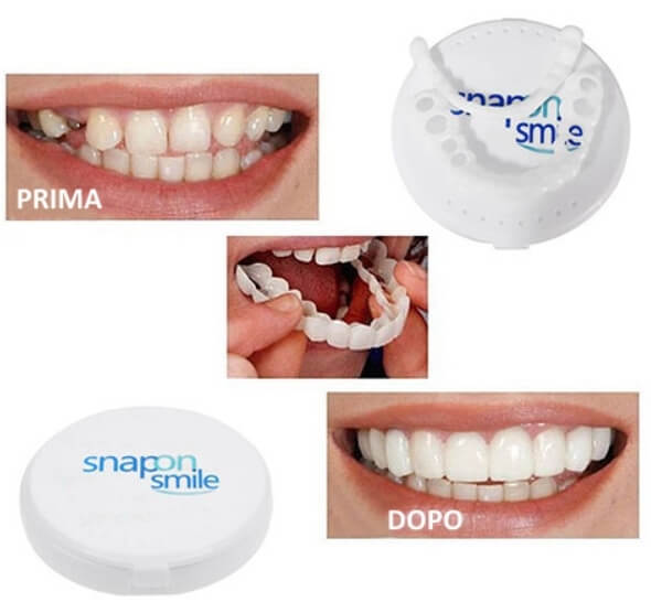 Snap-On Smile faccette dentali
